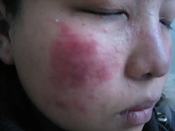 系统性红斑狼疮