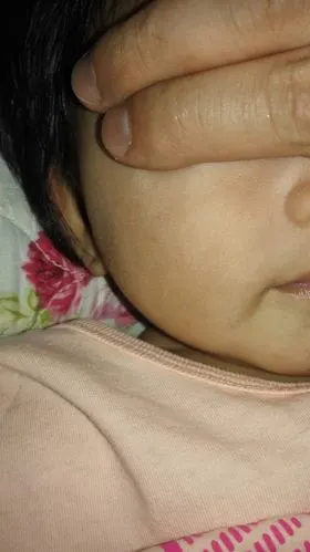 咖啡斑,请远离我的宝宝!