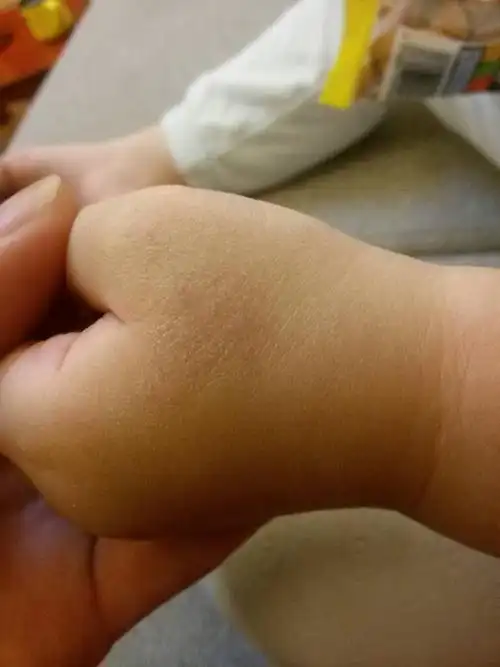 宝宝的手有一块像是煽了,很糙,摸了护手霜,已经3-4天了,也没有好.