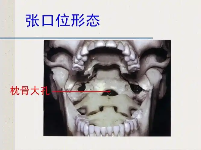 张口位形态 枕骨大孔