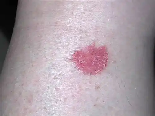 鳞状细胞癌怎么办鳞状细胞癌抗原偏高是什么意思皮肤高分化鳞状细胞癌