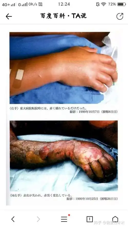 被超大剂量γ射线照射短时间内致死的人会有那些征象? - 知乎