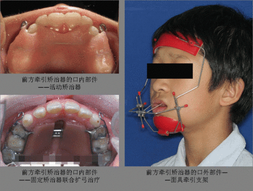 三,头帽颏兜牵引矫治器