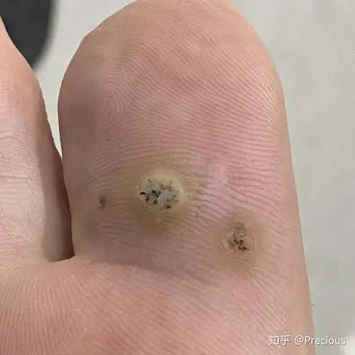 跖疣治疗过程快完全治愈了多图高能慎点