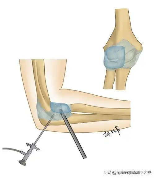 得了网球肘能治好吗?打封闭,小针刀,贴膏药这波操作别用了