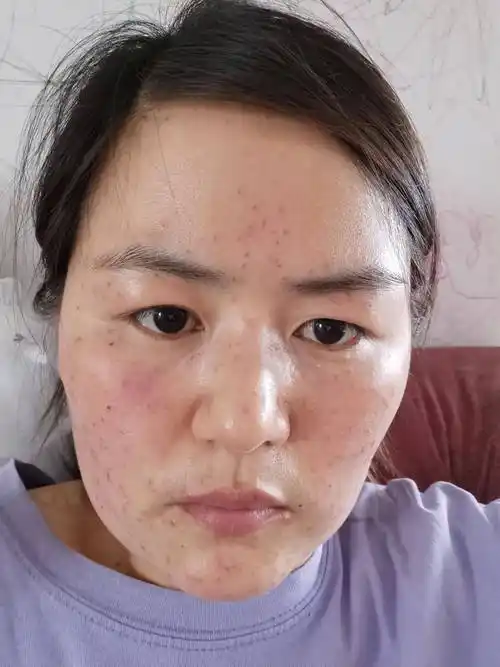 点斑多久恢复(牙签祛斑脱皮过程几天)_句子贝贝