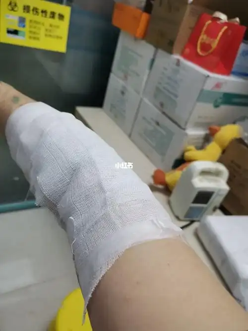 生理盐水冲洗,然后涂药92涂完药灭菌纱布块包扎一下,我懒省事儿,没