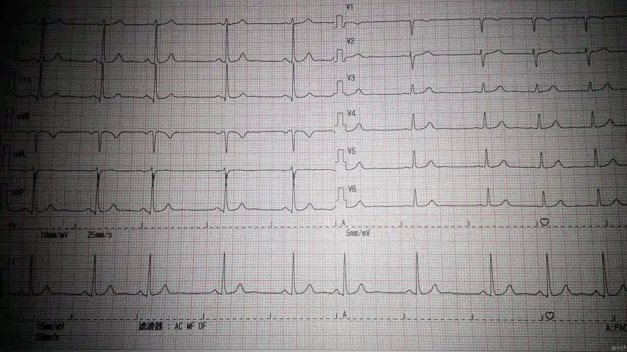 是单纯心律不齐吗 - 心电图脑电图专业讨论版 - 爱爱医医学论坛