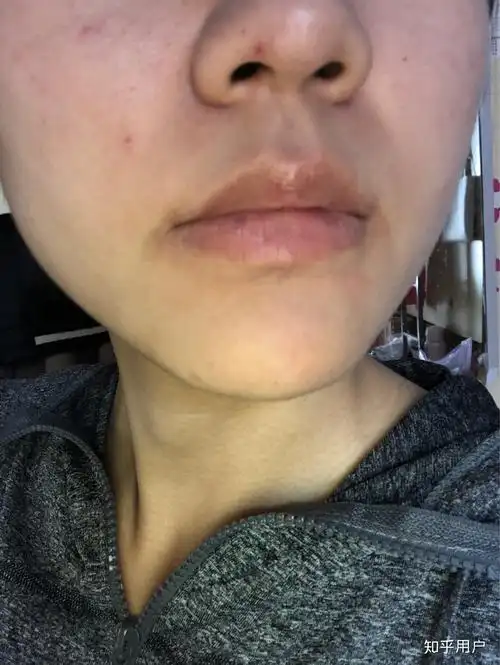 下嘴唇长黑斑是什么原因?