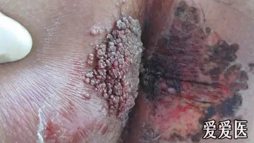 尖锐湿疣