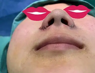 除了疤痕情况之外,还有一些做完鼻翼手术术后左右鼻孔不对称,这也是