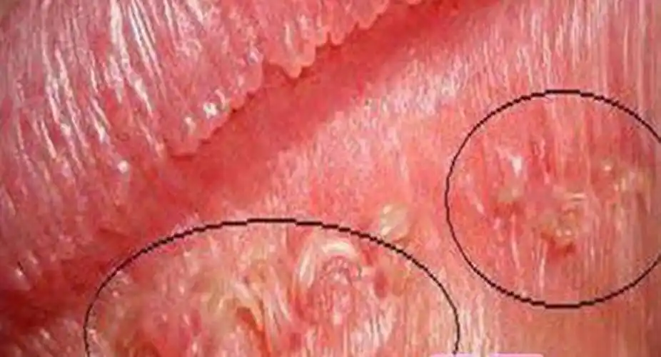 女性梅毒的危害有哪些