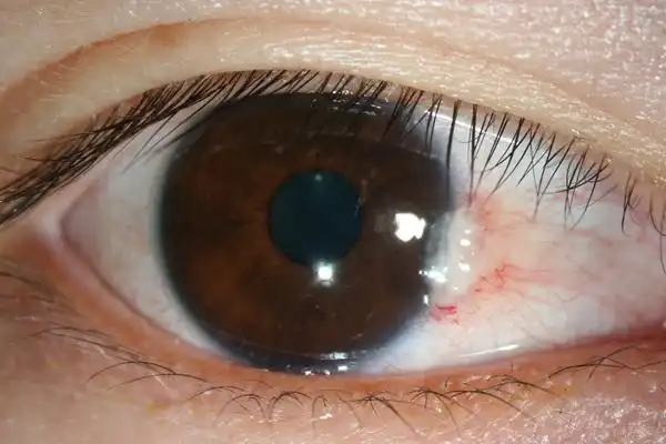 翼状胬肉怎么治疗?