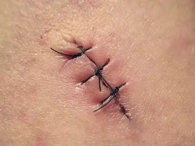 顺产时自然撕裂与侧切有什么不同产科医生站出来为大家说真话