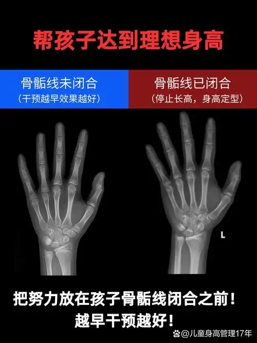 子的发育程度,而女孩骨龄到了14岁,男孩骨龄到了16岁,骨骺线接近闭合