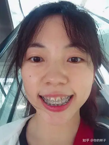 大龄女青年骨性嘴凸下巴后缩深覆合 - 知乎