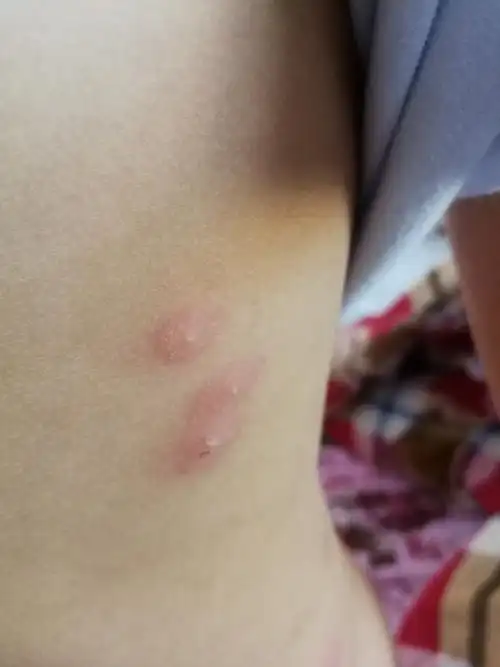 宝宝身上起了红包有脓点是什么?