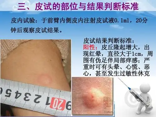 1ml,20分 钟后观察皮试结果.