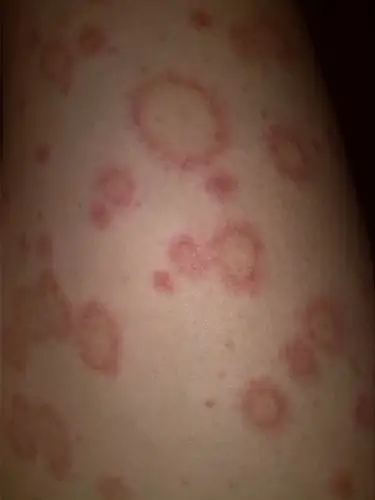 大小不一的圆形红斑,究竟是什么皮肤病呢?