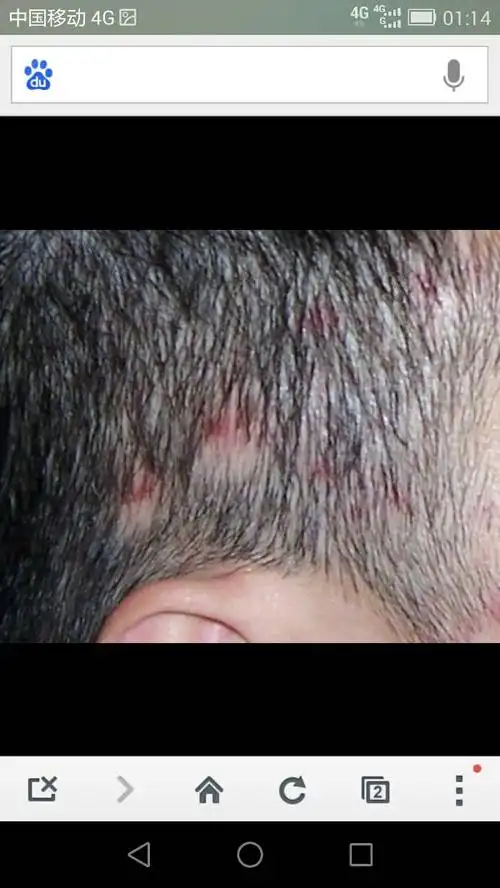 老公头上长了很多大小不一样的红色带脓的包,应该是毛囊炎,请问应该