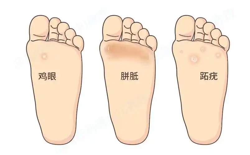 跖疣?傻傻分不清楚可不行!