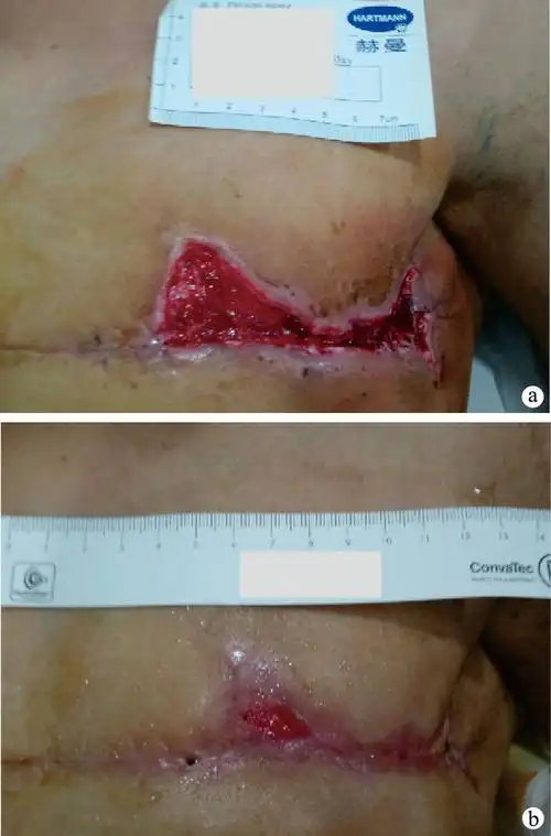 湿性疗法对乳腺癌根治术后皮瓣坏死的治疗效果