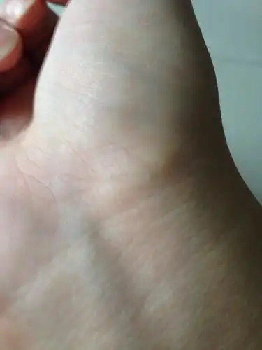 手腕的上方长了骨刺,只能手术剔除吗?