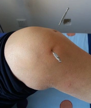 滑膜炎积液肿胀1把黄豆加1白肿胀积水全溜走了