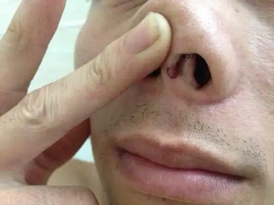 鼻窦炎症状图片 (44)