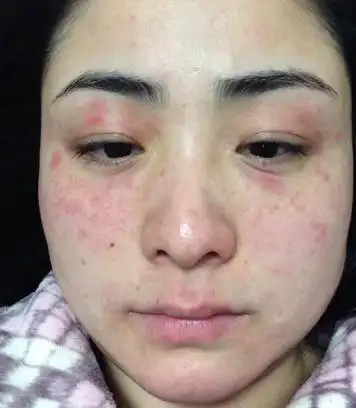 被污染的空气等,从而导致皮肤出现红肿,瘙痒,脱皮及过敏性皮炎等症状