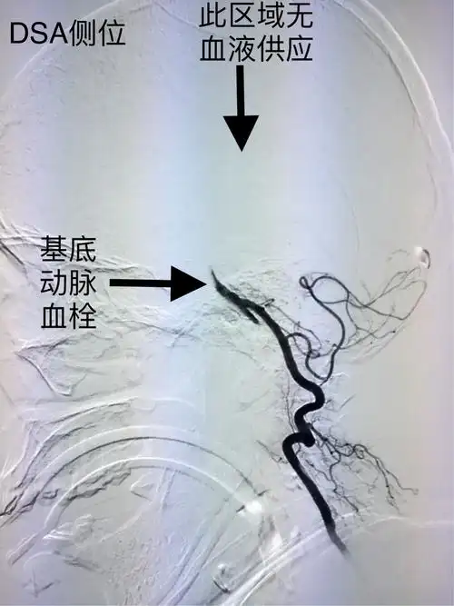 右侧椎动脉侧位造影显示基底动脉闭塞.