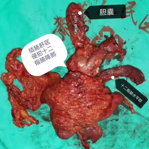 结肠肝曲局部晚期恶性肿瘤扩大切除经验分享