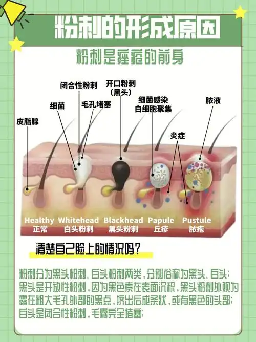 粉刺的形成原因丨三大因素清楚要怎么去除63