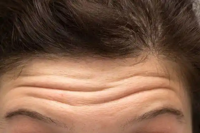 不敢相信才￥79不打针不开刀显老10岁额头纹抬头纹真的贴没了