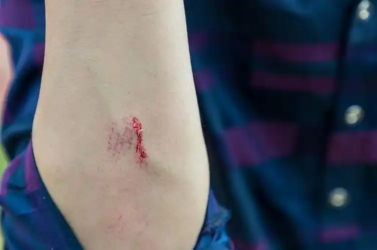 手臂被刀划伤图片