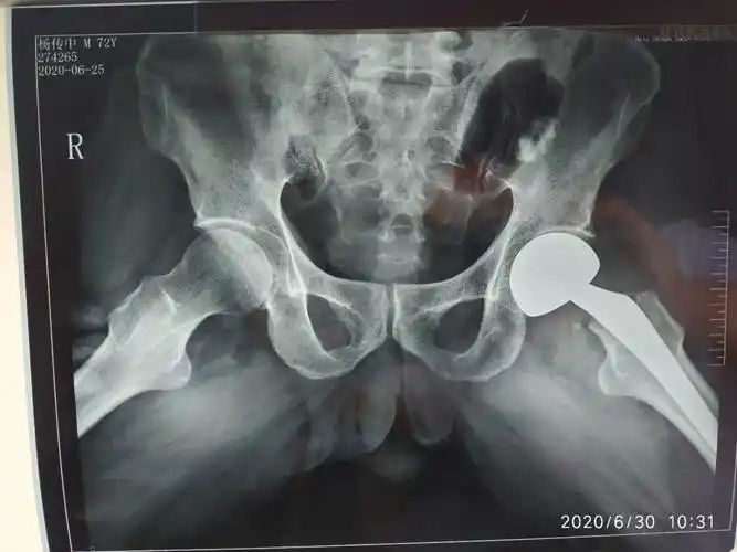 术后髋关节蛙式位,假体位置适中.