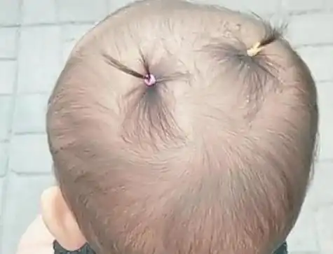 宝宝出生后,宝妈们一定是希望孩子有浓密的头发,可是有的宝宝就顶着"
