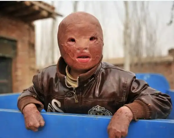 水火无情,小孩被烧