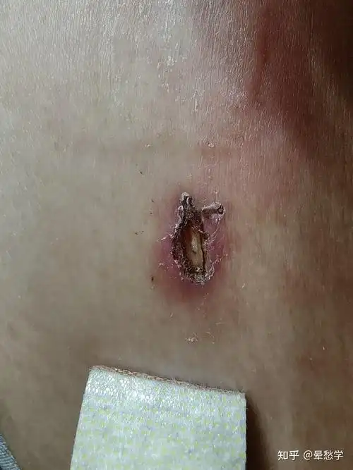 腹腔镜宫腔镜手术子宫肌瘤宫颈赘生物摘除术前术后经验分享