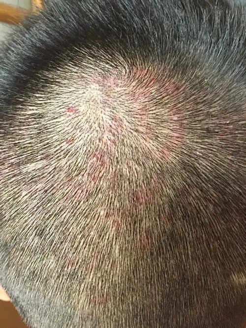 头皮起疙瘩 有的带白头脑 碰会疼几个月了 请懂的看下 谢谢啦