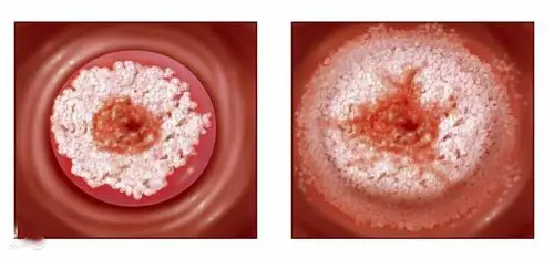 那啥过早容易得宫颈癌,90岁奶奶不屑的笑了