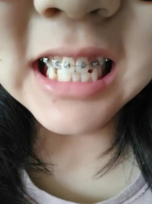 右边牙已经正常了,大门牙和左边的牙正在慢慢正常