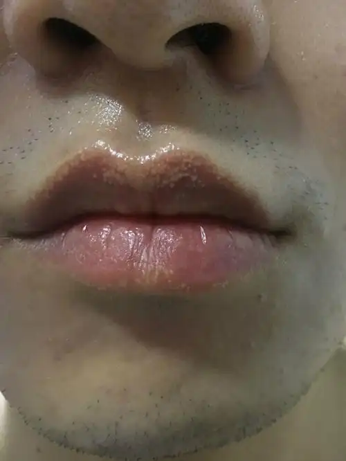 3,病理表现在组织病理学上主要见到小而成熟的皮脂腺小叶包绕着皮脂腺