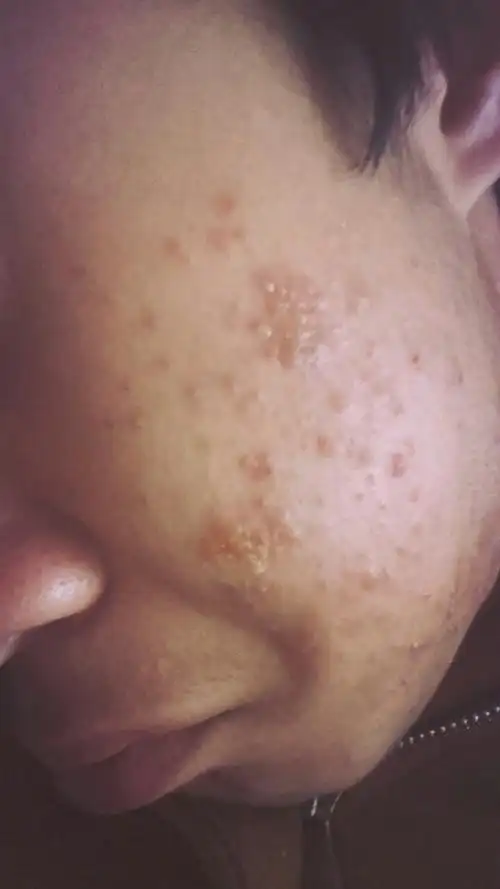 痘痘结痂了,可是稍微用力一碰就会流水!