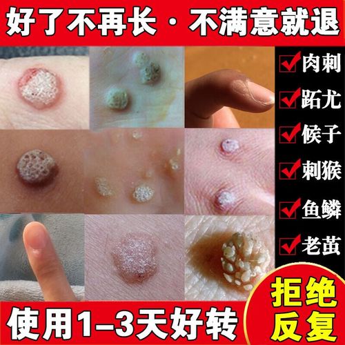 【药房直发】药鱼鳞痣祛肉粒疙瘩治瘊子休子药刺猴药去除 刺猴药去除