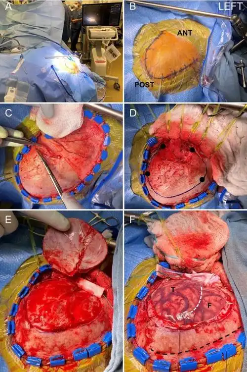 大脑半球切除的手术适应证是重度的,药物难治性,致残性癫痫发作患者