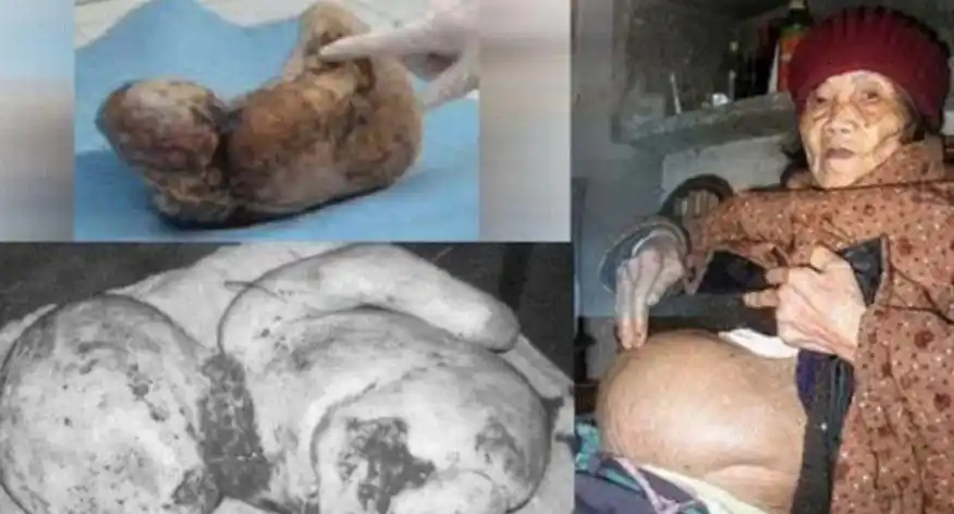 为了腹中胎儿 已死亡2天的妈妈竟创造奇迹