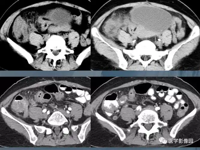 阑尾炎的ct诊断