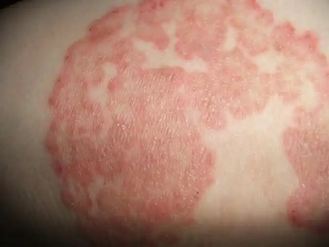 导致湿疹疾病发生的原因_上海江城皮肤病医院