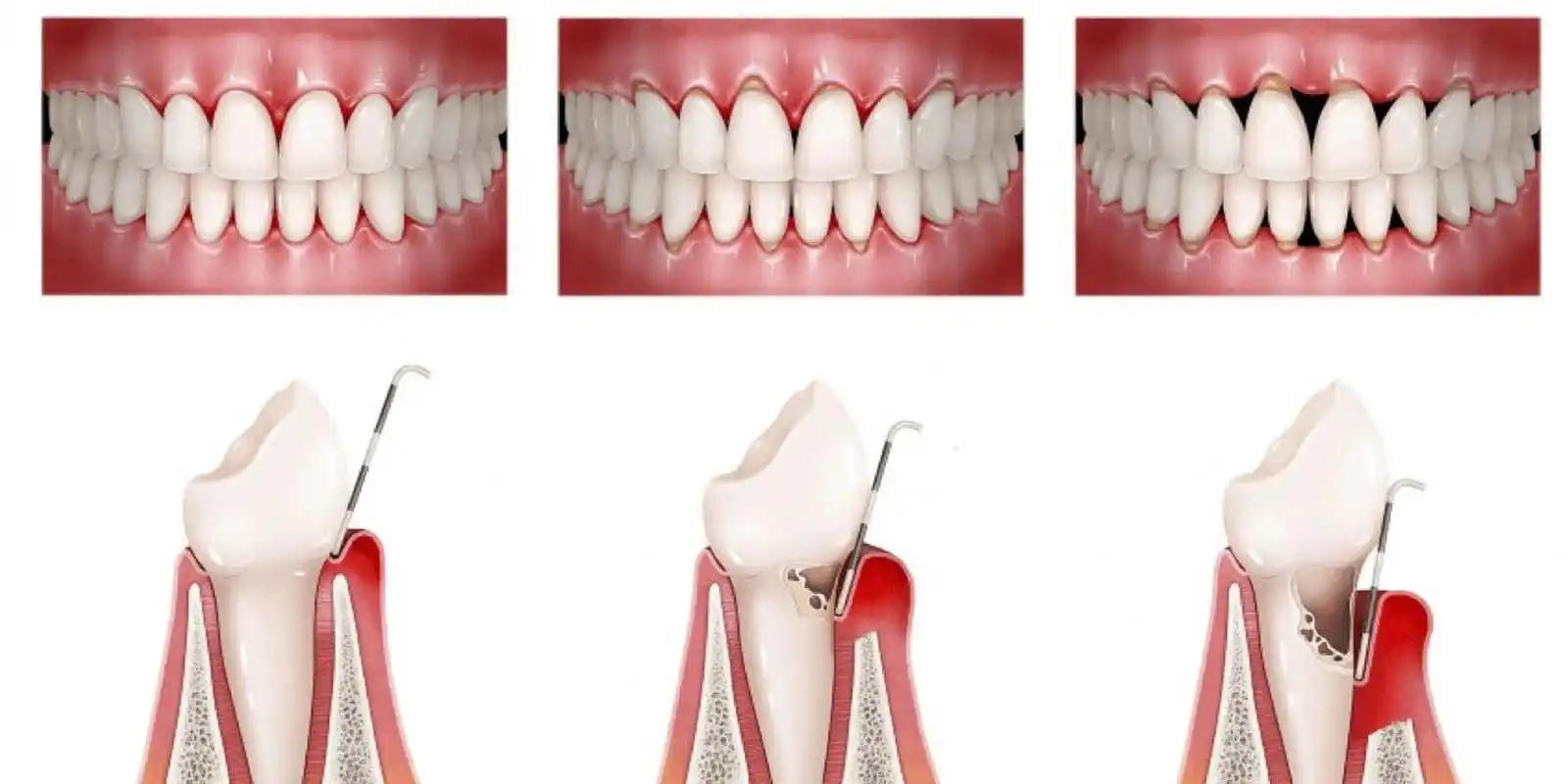 牙龈萎缩7215牙槽骨吸收怎么办71 9999697115牙周炎